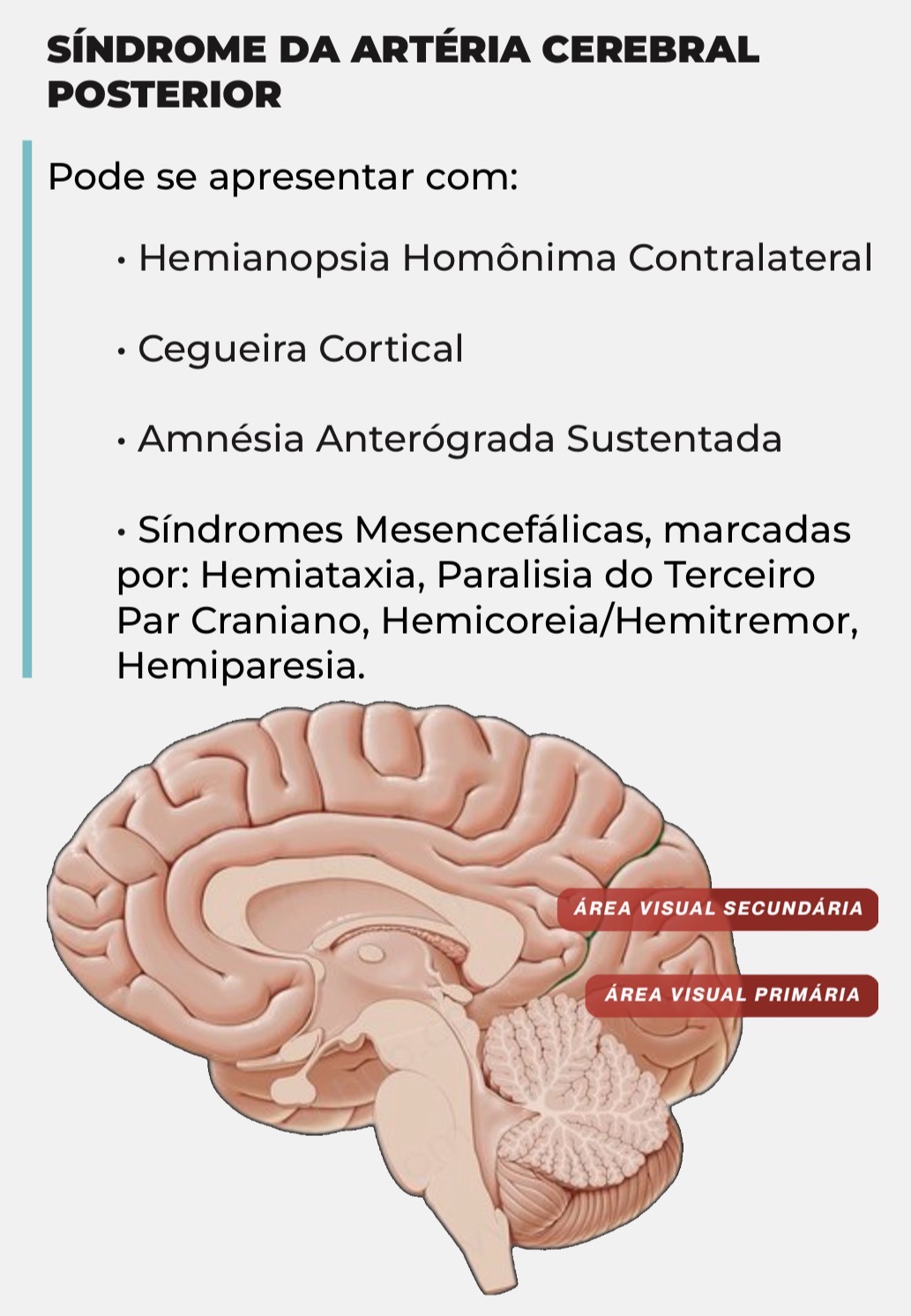 Página do Guia sobre a Síndrome da Artéria Cerebral Posterior