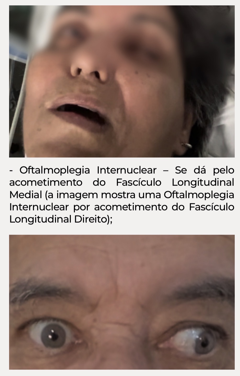 Página do Guia sobre Oftalmoplegia Internuclear